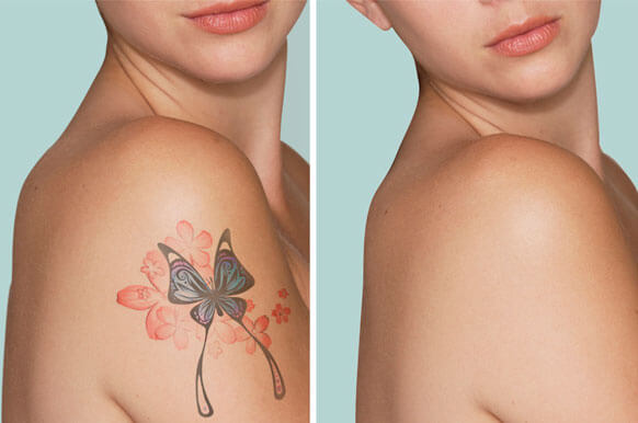 Tattoo Removal Brentwood  NdYAG Laser